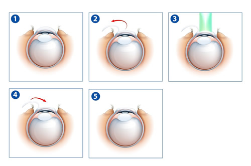 Cirurgia a Laser