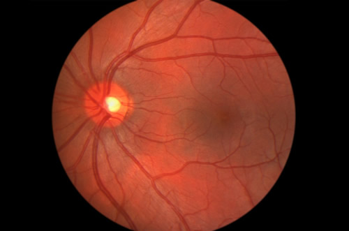 Retina